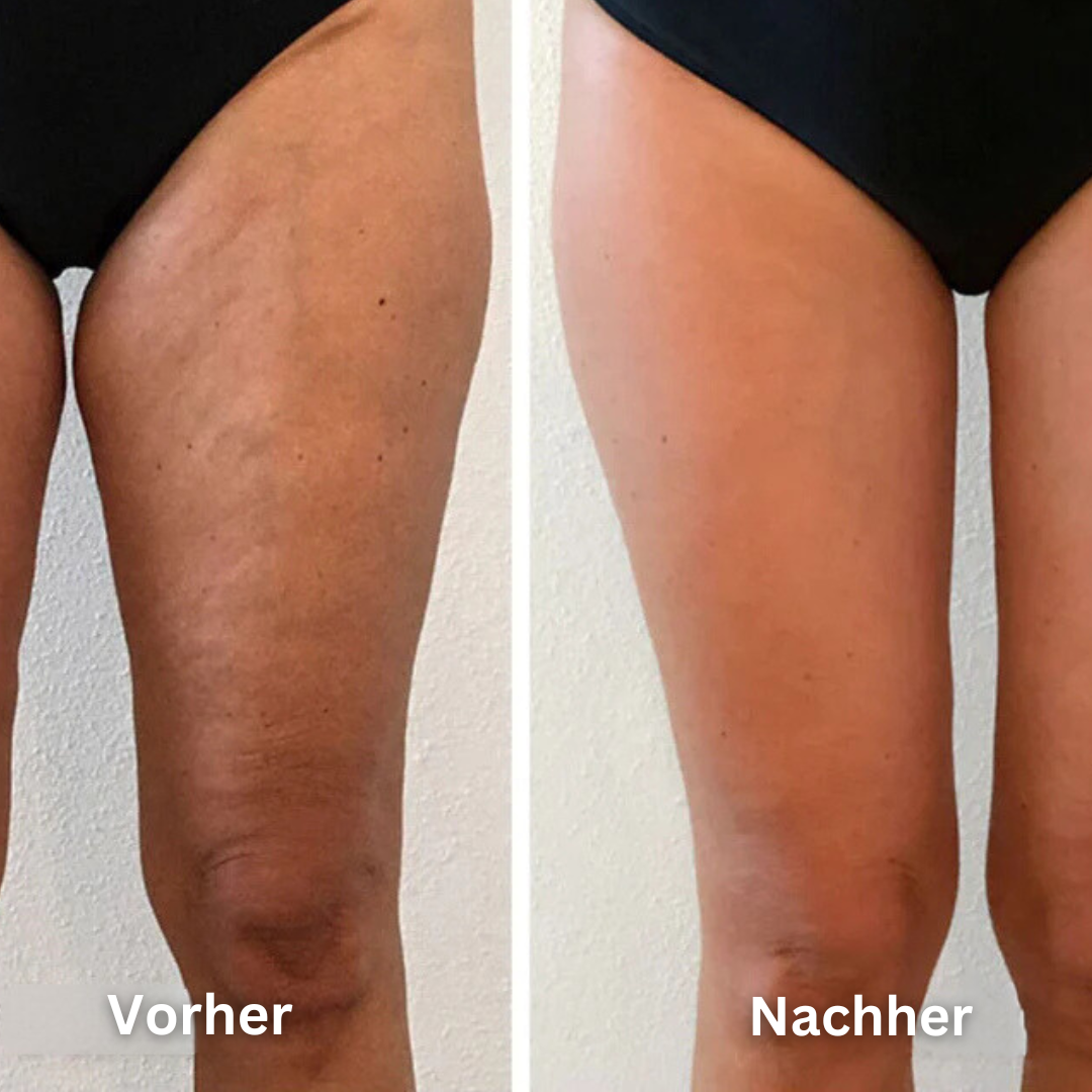 SlimGlow Anti Cellulite