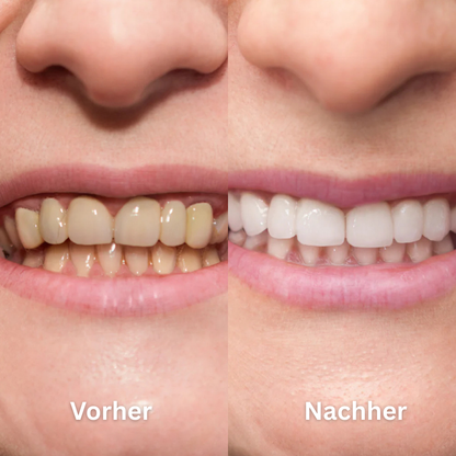 SmilePure Ultraschall Zahnreiniger