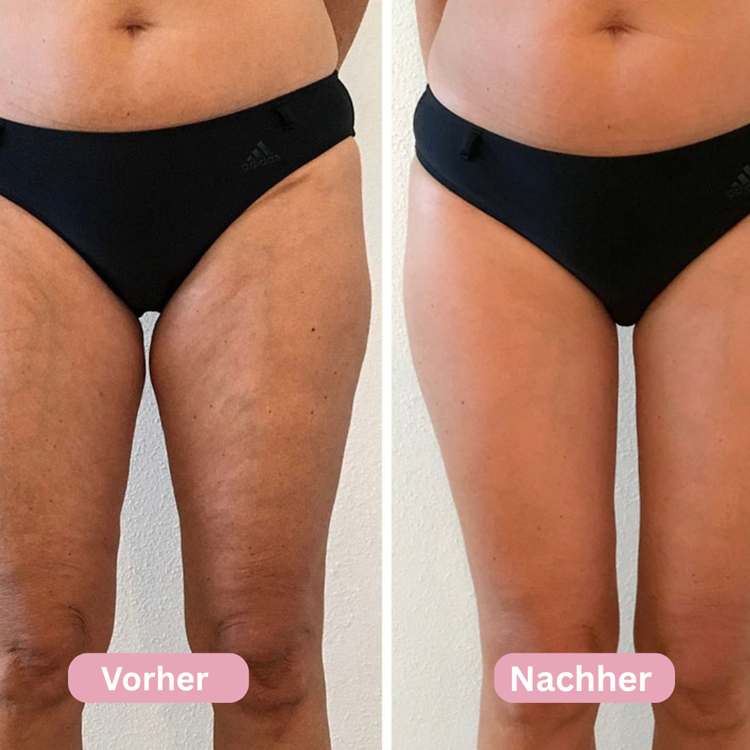 Celluvia Anti-Cellulite Massagegerät